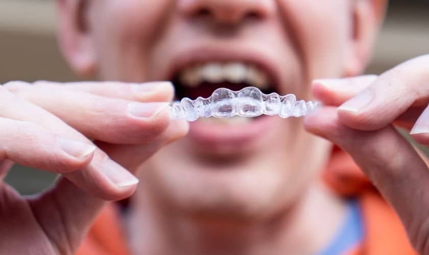 Invisalign White