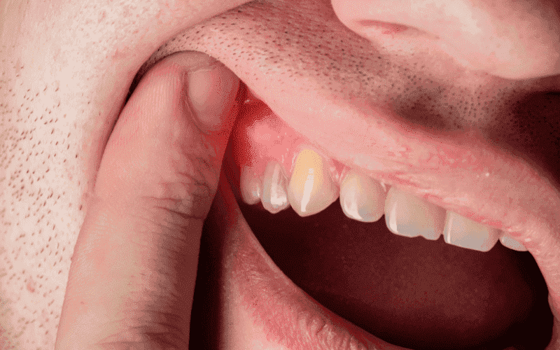 periodontal disease