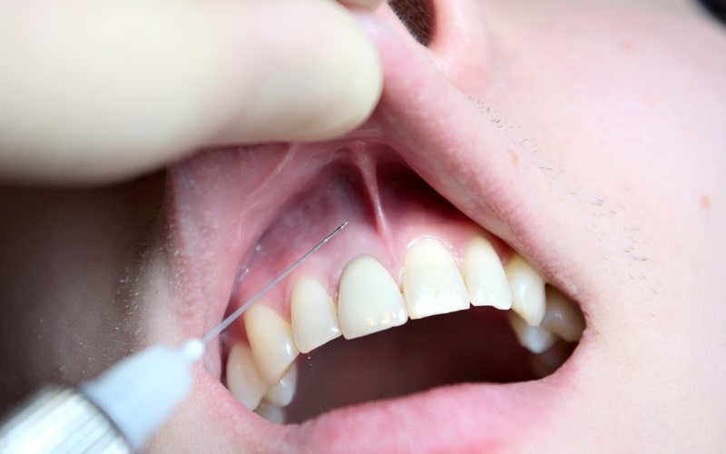 Do You Need Anesthesia For Tooth Extraction